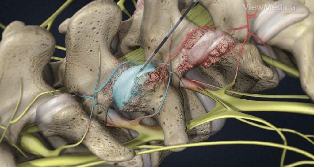 Facet Joint Pain