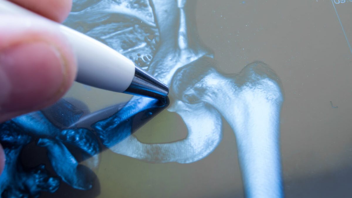 Types of Osteotomy Procedures Performed By A Neurosurgeon Types of Osteotomy Procedures Performed By A Neurosurgeon