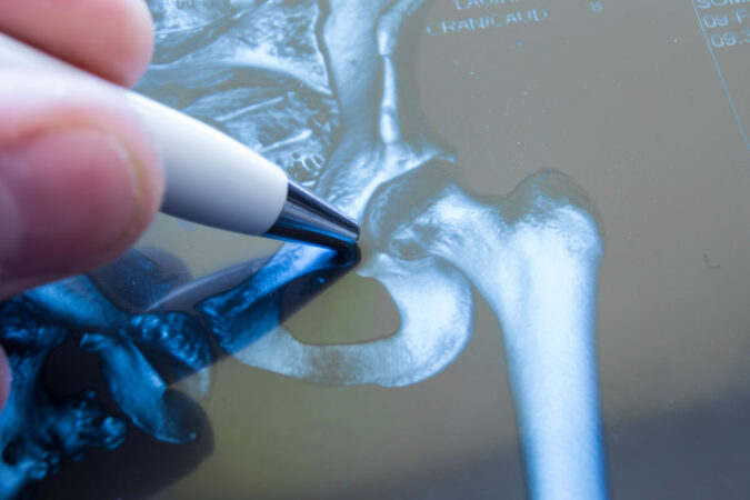 Types of Osteotomy Procedures Performed By A Neurosurgeon Types of Osteotomy Procedures Performed By A Neurosurgeon