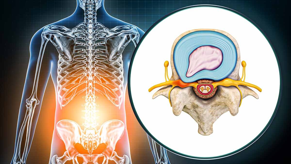 Micro-Discectomy for Herniated Discs Micro-Discectomy for Herniated Discs