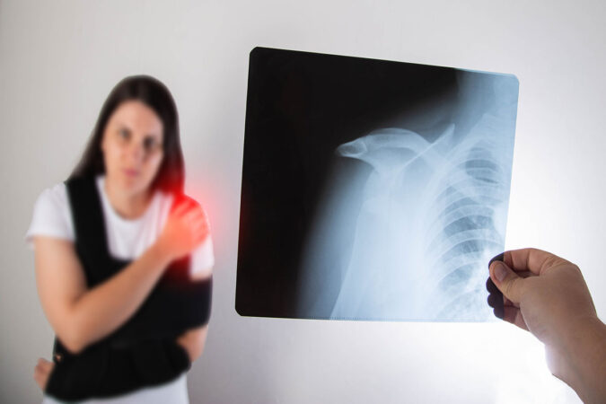 Treatment Options for a Dislocated Shoulder
