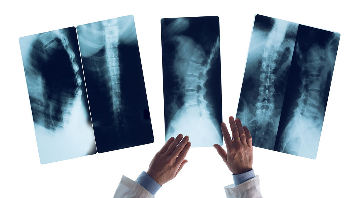 Worried About Complications From A Kyphoplasty Procedure? Let Us Ease Your Mind! Worried About Complications From A Kyphoplasty Procedure? Let Us Ease Your Mind!