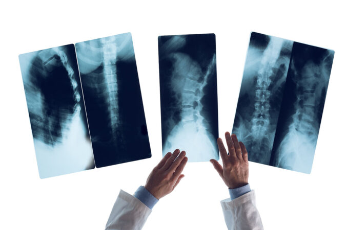 Worried About Complications From A Kyphoplasty Procedure? Let Us Ease Your Mind! Worried About Complications From A Kyphoplasty Procedure? Let Us Ease Your Mind!