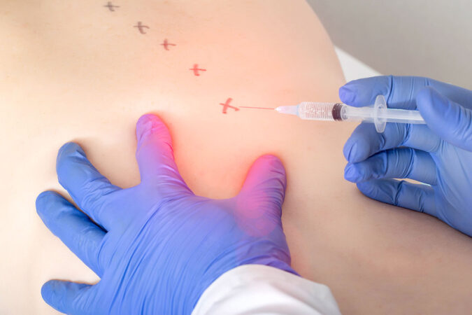 Can an Epidural Steroid Injection Work for Your Inflammation? Can an Epidural Steroid Injection Work for Your Inflammation?