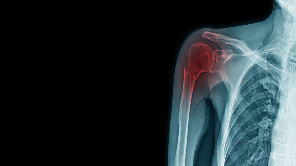 What is a Rotator Cuff Tear? What is a Rotator Cuff Tear?