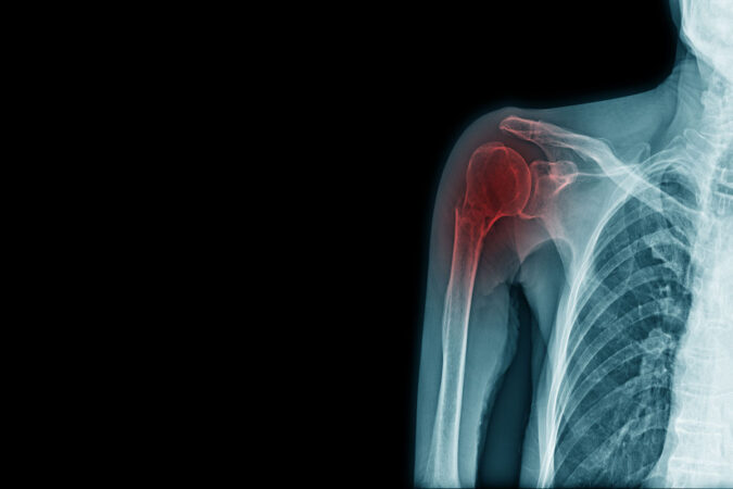 What is a Rotator Cuff Tear?