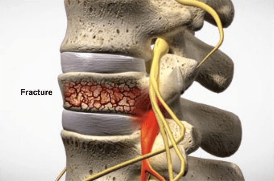 what does spinal stenosis look like?