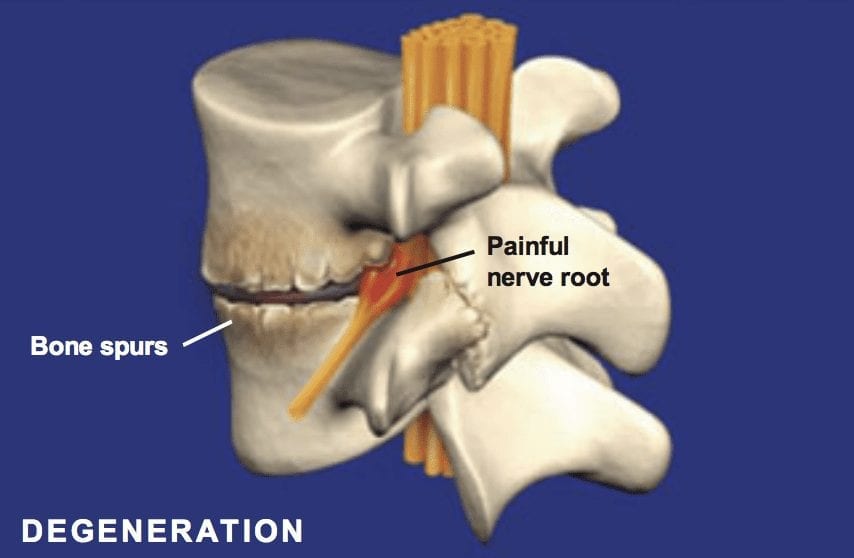 Spondylosis Symptoms