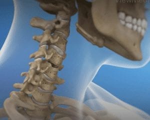 3d image showing artificial disc complications