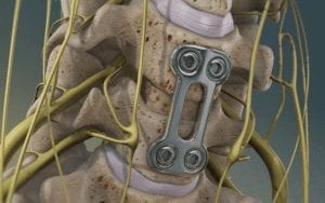 Anterior cervical discectomy and fusion