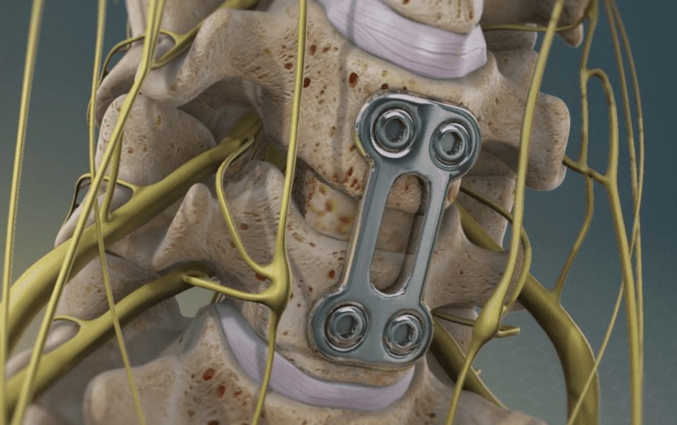 Anterior cervical discectomy and fusion