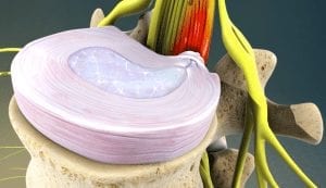 bulging disc image