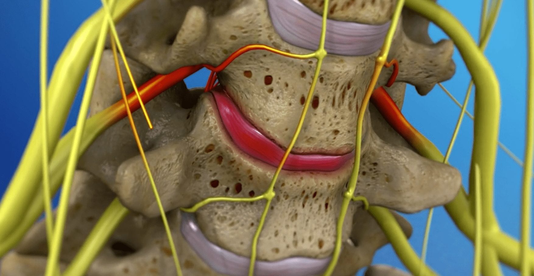 Damaged Spine