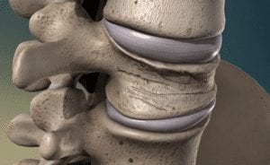 Is Degenerative Disc Disease Dangerous