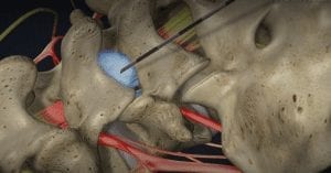 Injections for Back Pain
