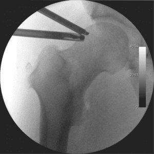 Guided surgery