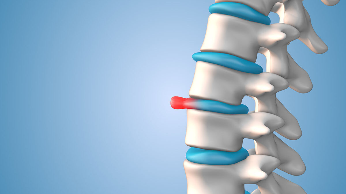 How Do You Know If You Have a Slipped Disc?