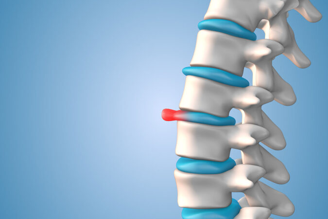 How Do You Know If You Have a Slipped Disc? How Do You Know If You Have a Slipped Disc?