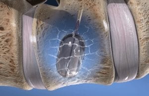 Kyphoplasty Recovery Time
