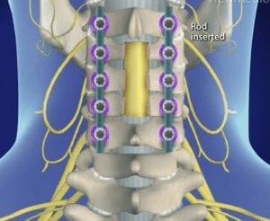 Laminectomy procedure