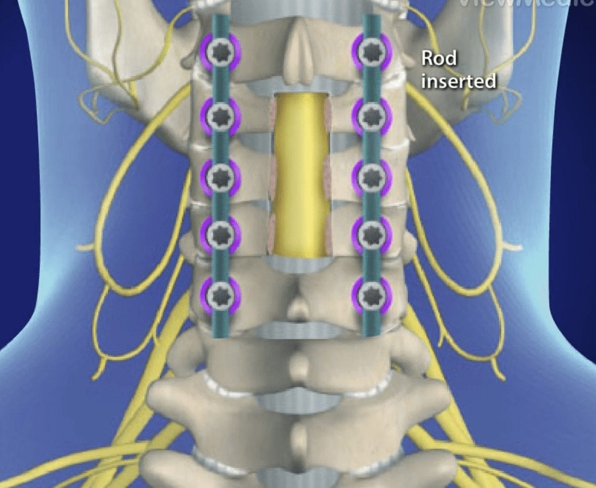 Laminectomy procedure