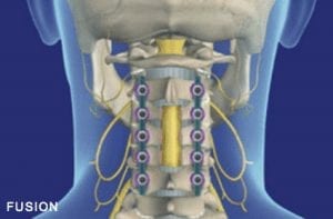 Laminectomy Surgery Recovery