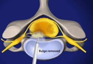 Diagram showing Micro-Discectomy procedure in Florida