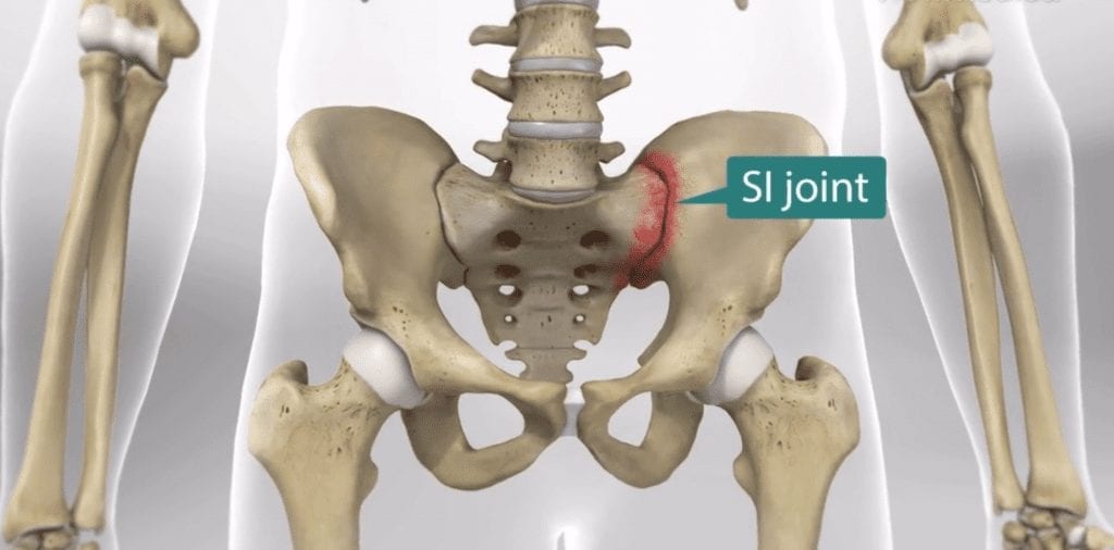 Image used for SI joint pain education