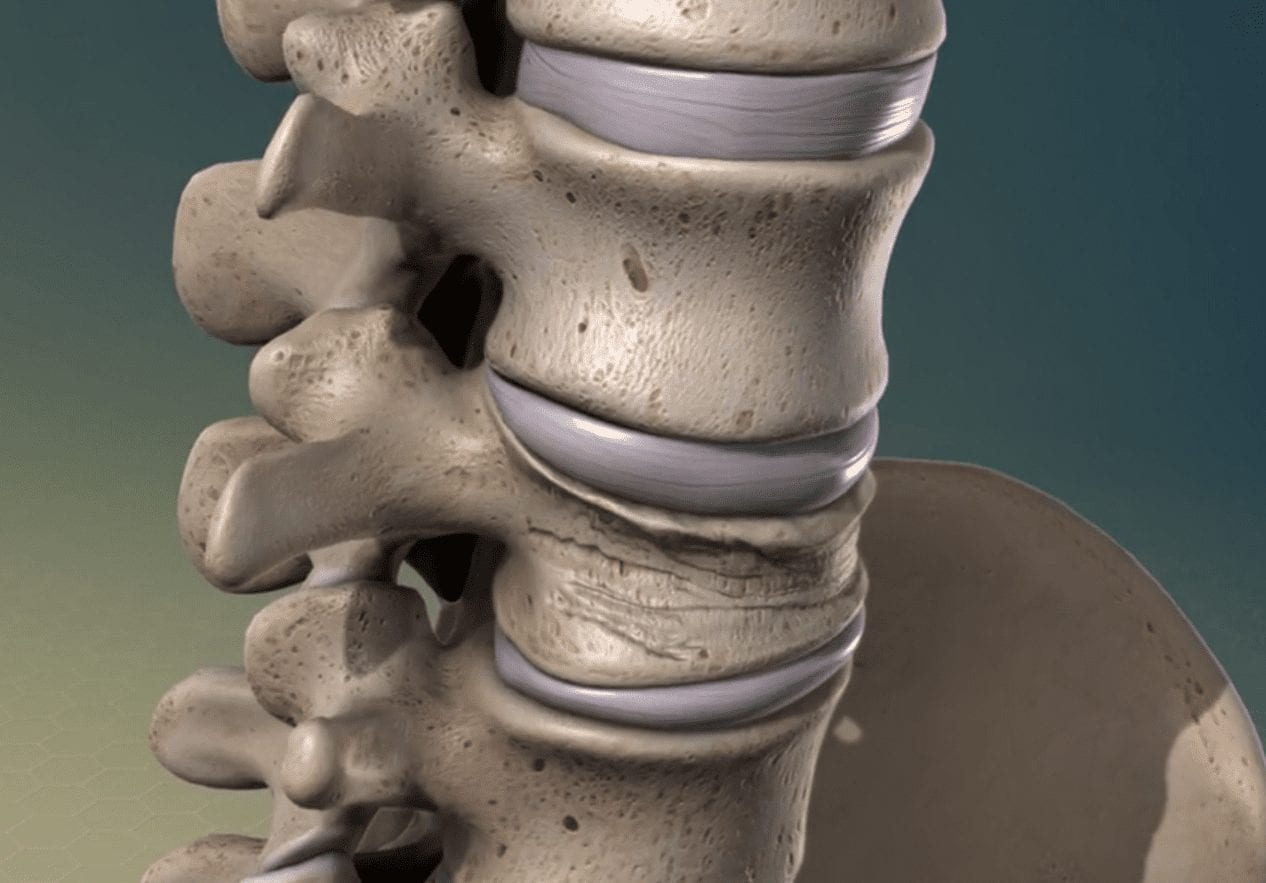 Spinal Arthristis What causes Spinal Arthritis