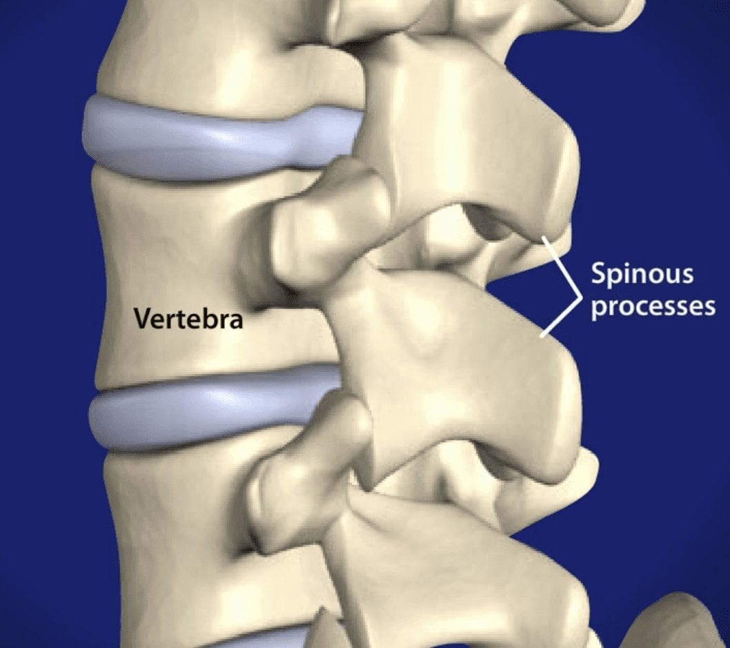 Spinous Process Pain