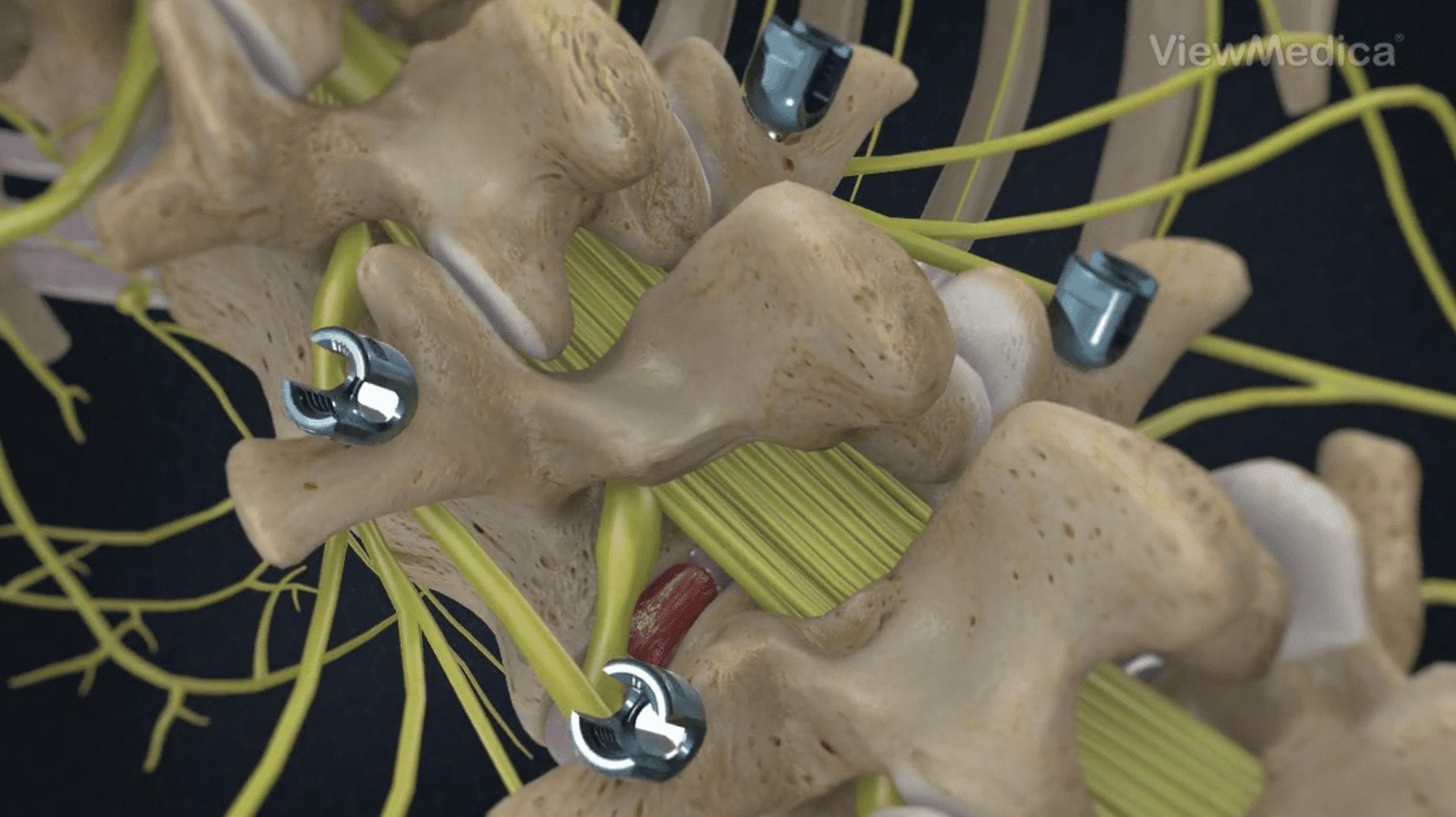 Image showing TLIF surgery in Florida