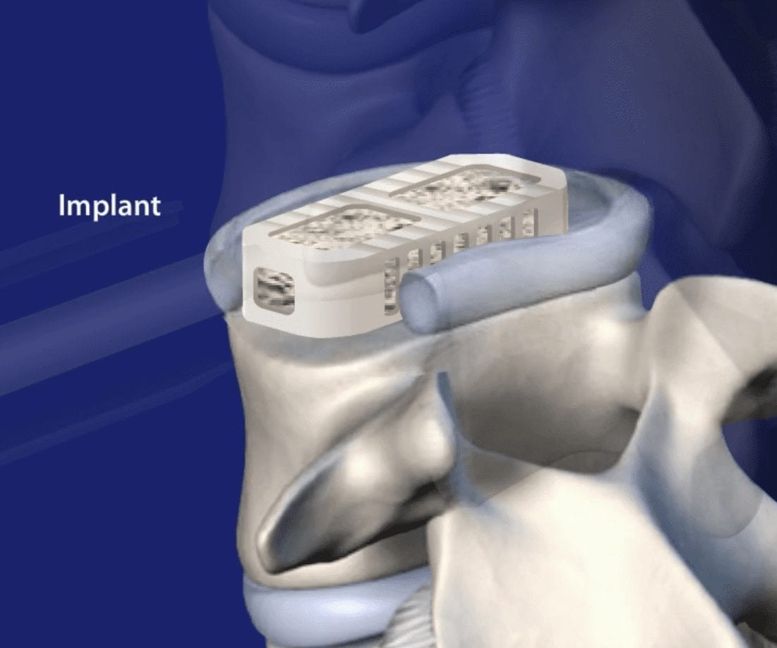 extreme lateral interbody fusion surgery