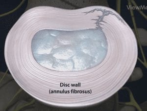Diagram showing an annular tear in spine
