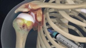 Joint Injection photo