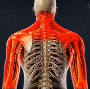 Epidural Steroid Injection for neck pain