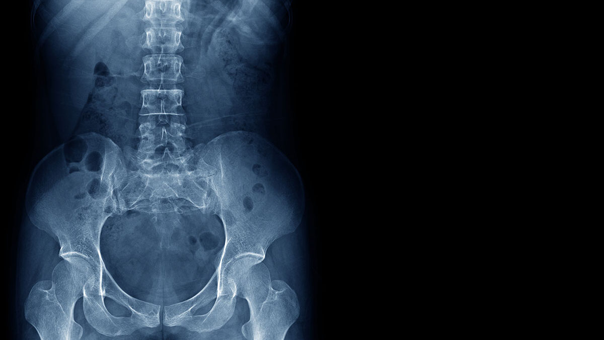 Laser Spine Surgery – Are You A Candidate?​