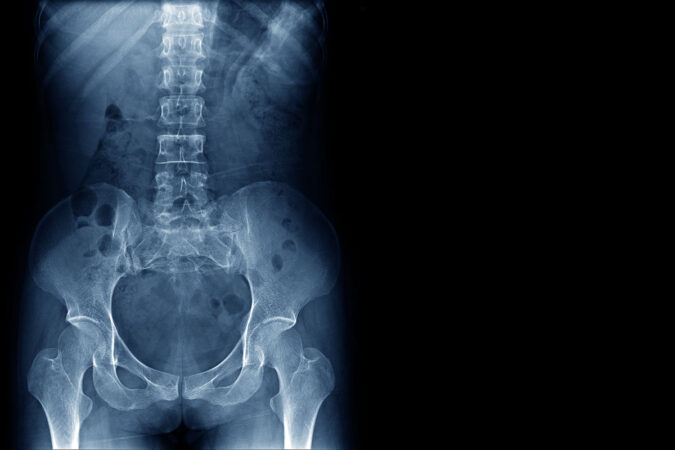 Laser Spine Surgery – Are You A Candidate?​