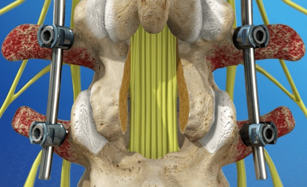 Lumbar Spine Fusion Recovery