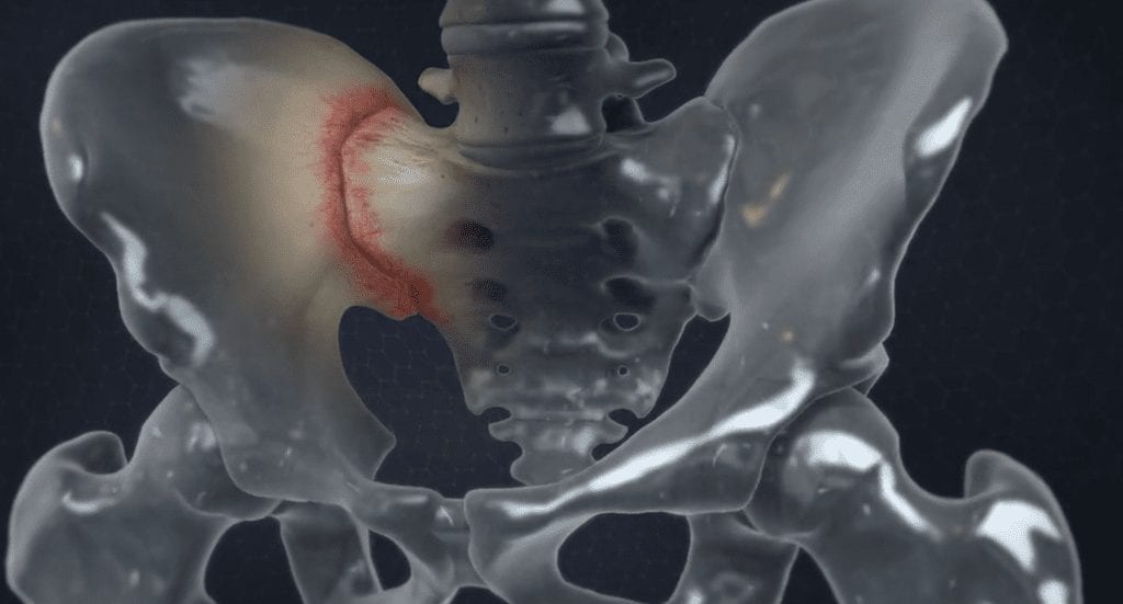 SI Joint Pain