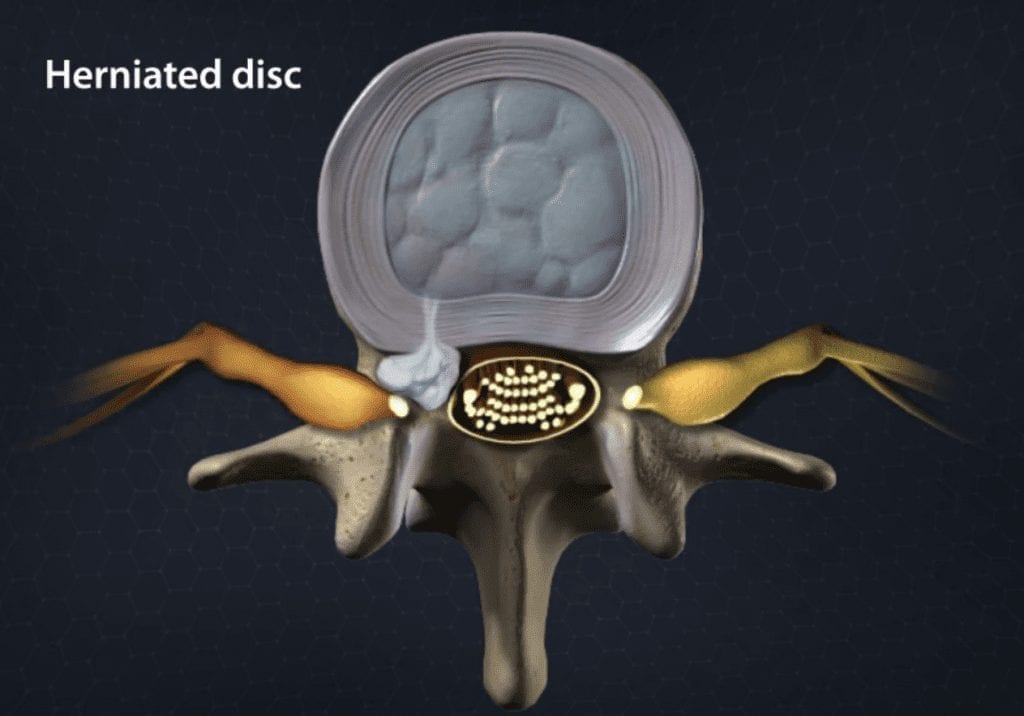 Herniated Nucleus Pulposus