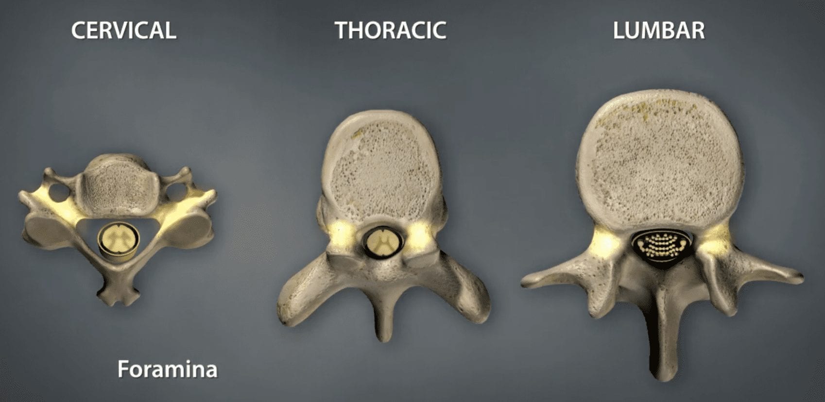 Foraminal Stenosis