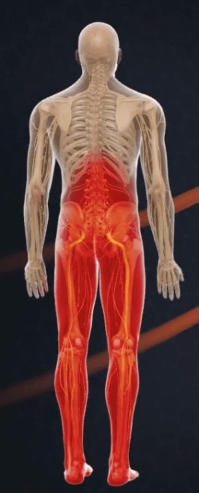 Low Back Pain