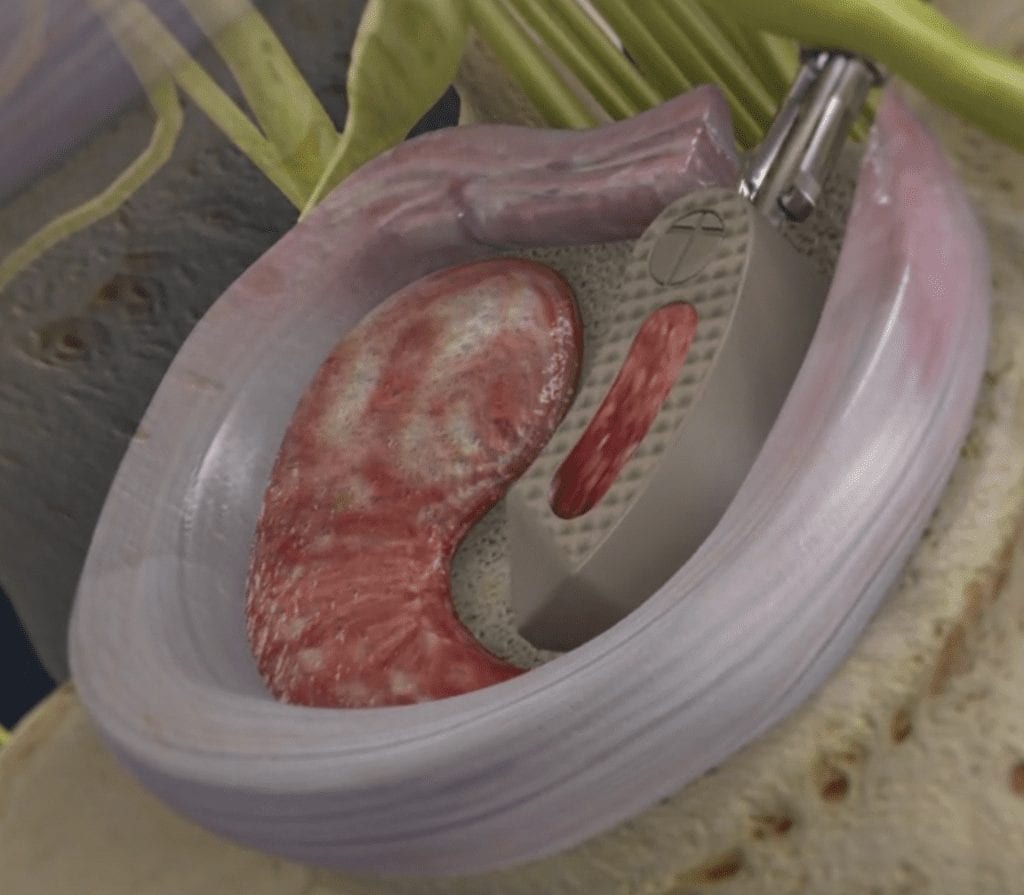 TLIF Graft