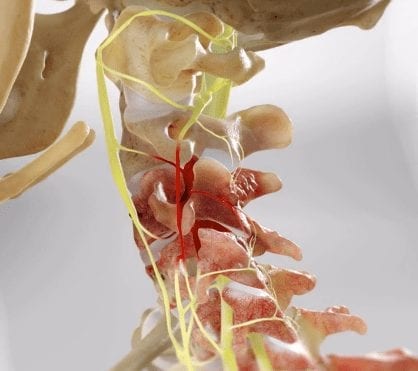 Neck Pain