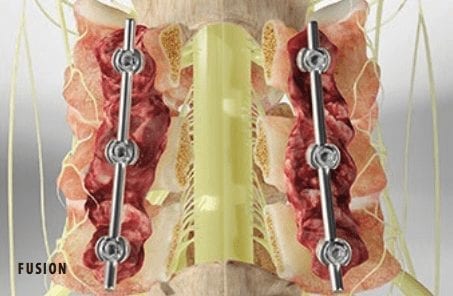 Laminectomy Fusion