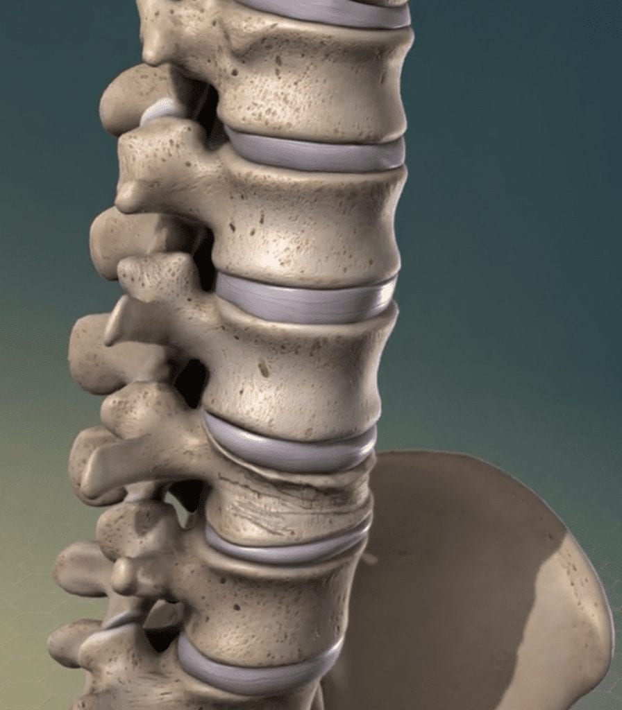 Compression Fractures
