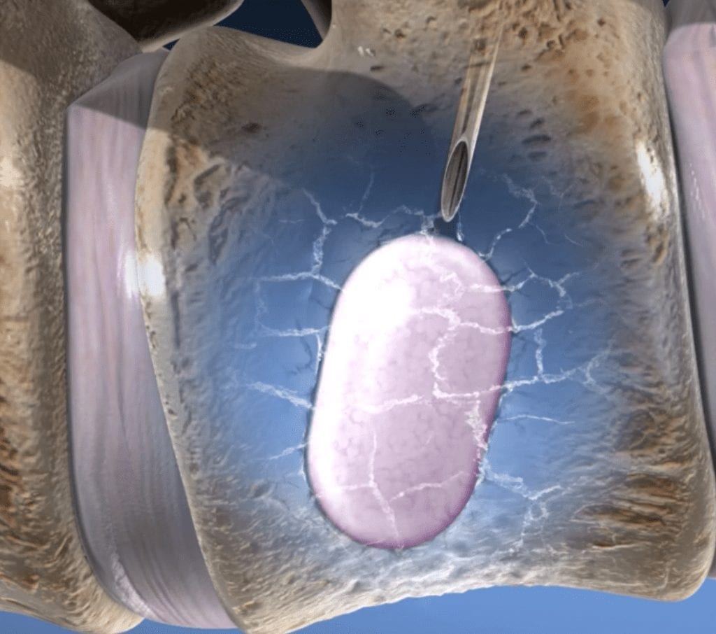 Kyphoplasty Balloon