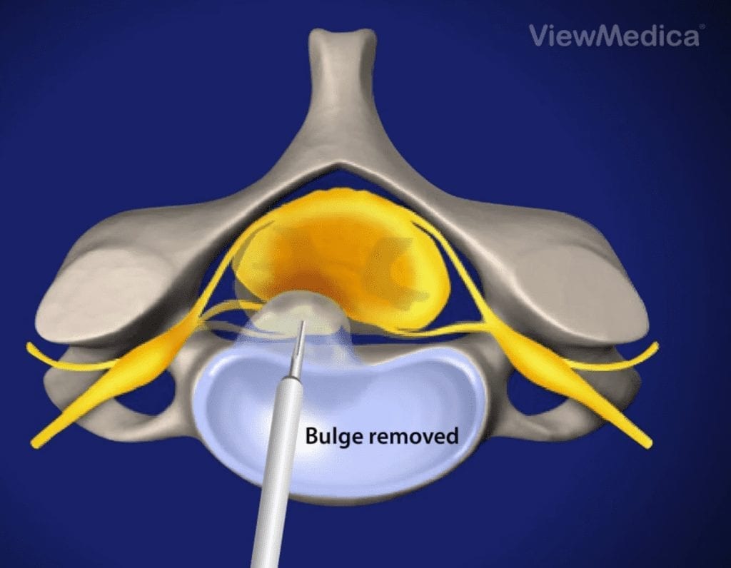 Microdiscectomy