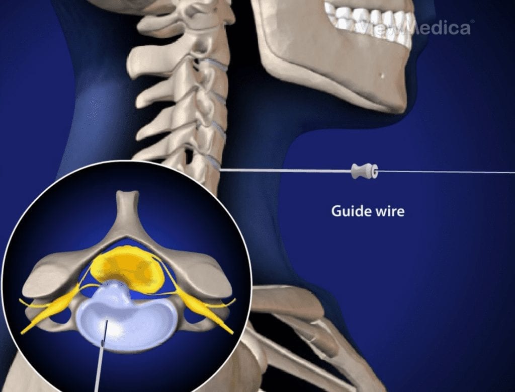 Microdiscectomy guide wire