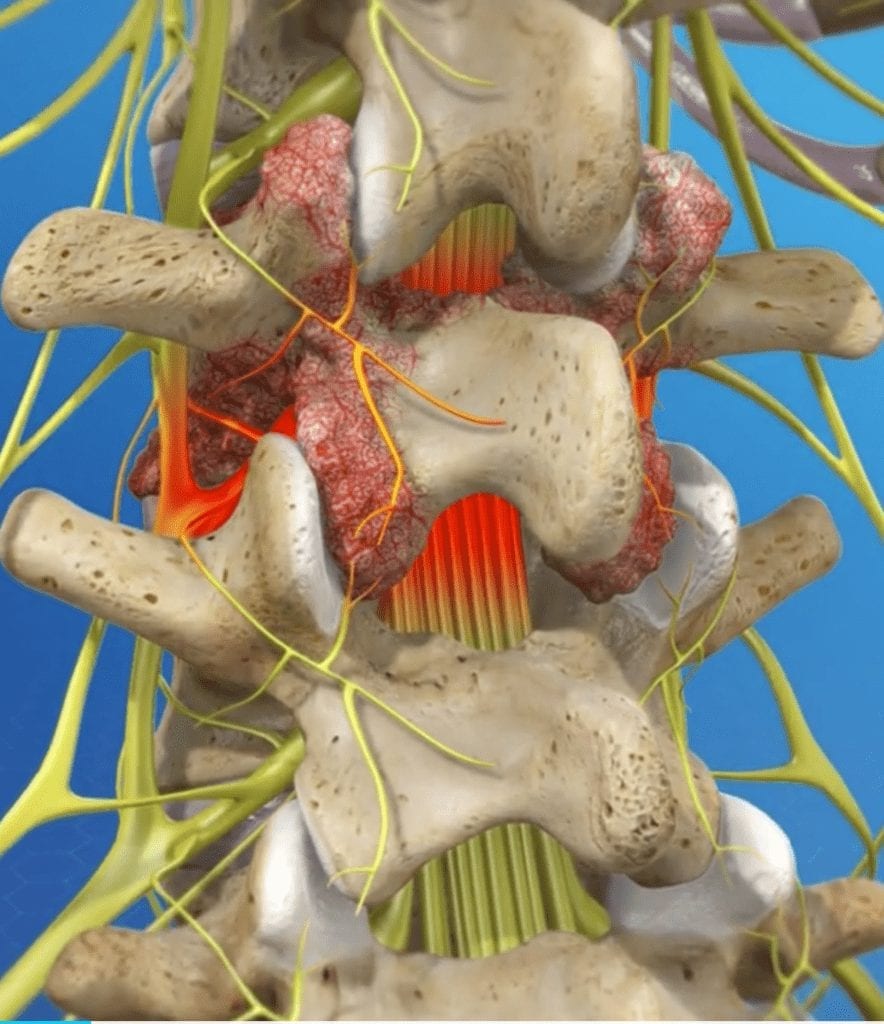 Spinal Fusion